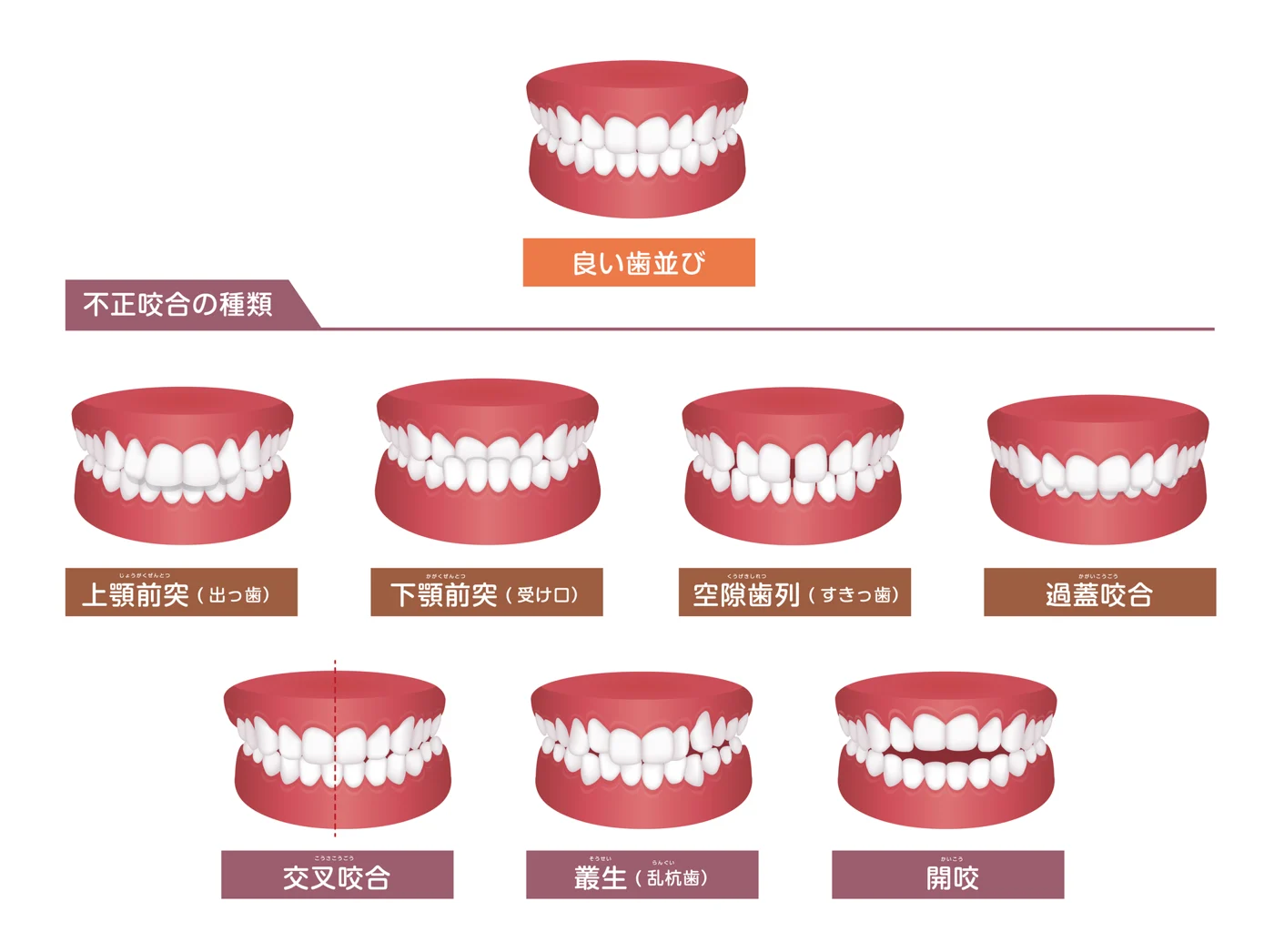 交叉咬合とは？上下の歯が横にずれる噛み合わせの原因と治療法【日本歯科札幌院長が解説！】の参考画像