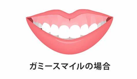 ガミースマイル矯正で悪化って本当？原因と対策を徹底解説！【静岡歯科が解説！】の参考画像