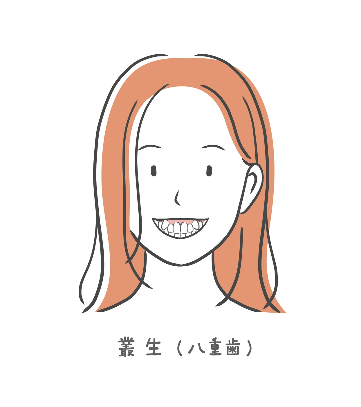 八重歯は部分矯正できない？全体矯正が必要なケースを解説します【日本歯科札幌院長が解説！】の参考画像