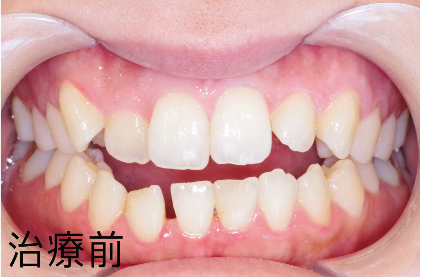 30代女性Dのマウスピース矯正(治療前/途中経過1):治療前